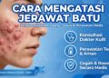 Cara Mengatasi Jerawat Batu Besar Meradang Yang Nyeri Dan Membandel